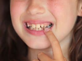 Jeder dritte Erstklässler in Flensburg hat bereits Zahnfüllungen Jeder dritte Erstklässler in Flensburg hat bereits Zahnfüllungen